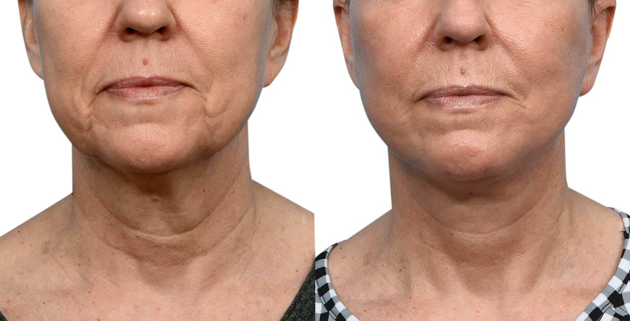 CO2 Laser Before & After Gallery - Patient 131363 - Image 1