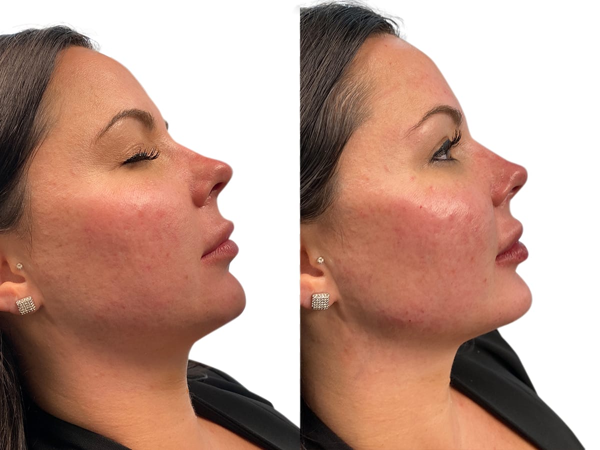 Liquid Facelift Before & After Gallery - Patient 416970 - Image 1