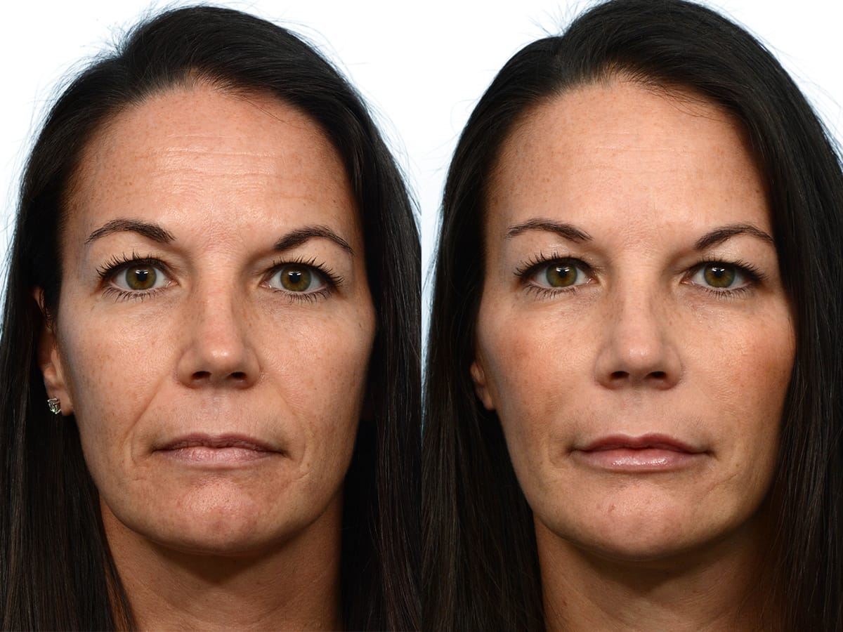 Liquid Facelift Before & After Gallery - Patient 268361 - Image 1