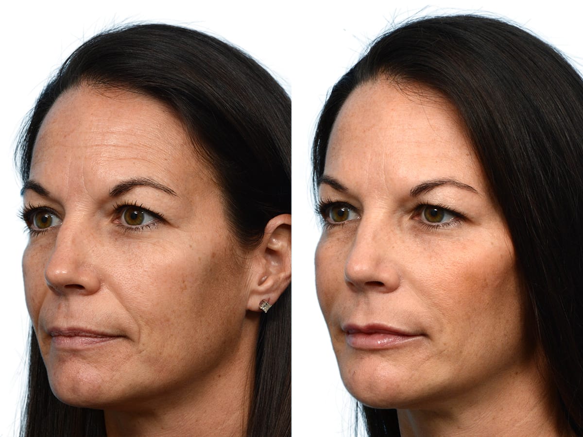 Liquid Facelift Before & After Gallery - Patient 268361 - Image 2
