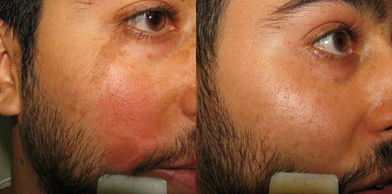 Picoway® Before & After Gallery - Patient 232957 - Image 1