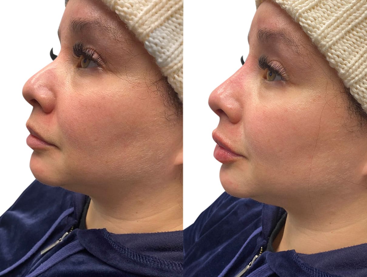 Non-Surgical Rhinoplasty Before & After Gallery - Patient 181434 - Image 1