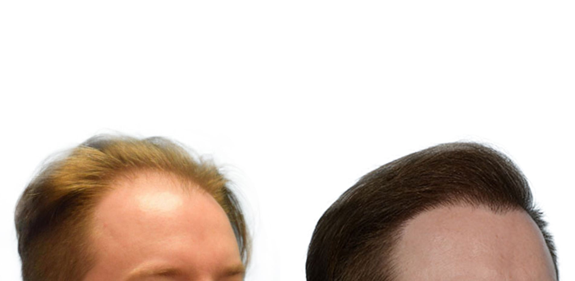 Hair Restoration  Before & After Gallery - Patient 287793 - Image 2