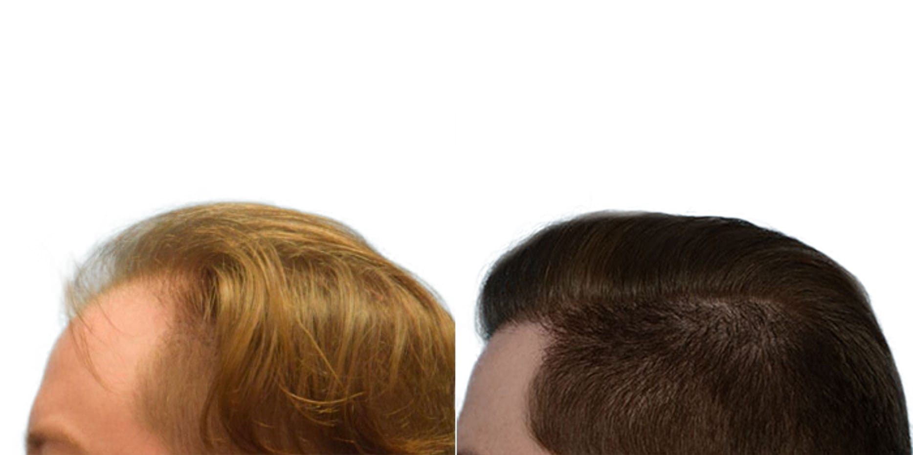 Hair Restoration  Before & After Gallery - Patient 287793 - Image 3
