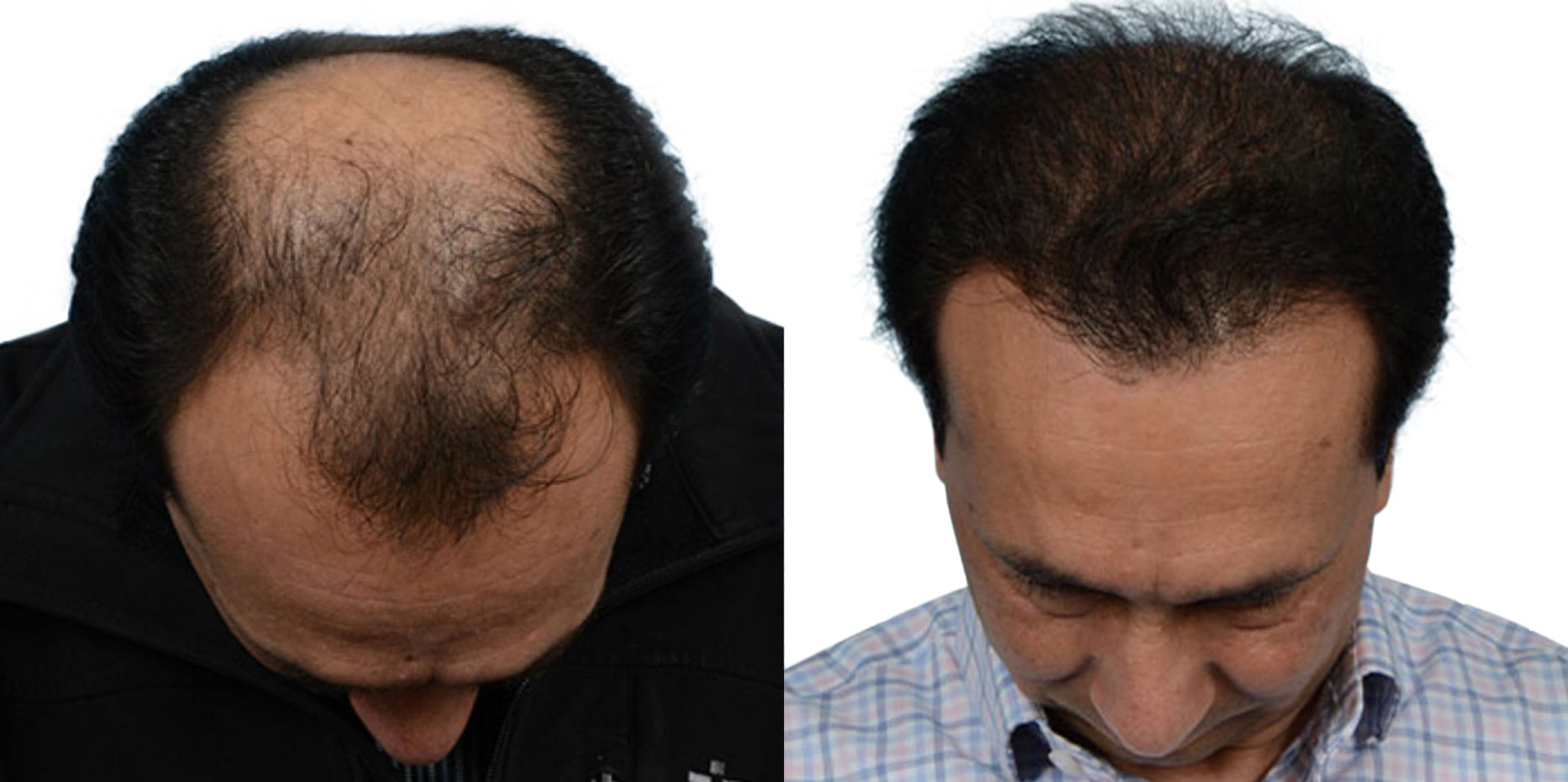 Hair Restoration Before & After Gallery - Patient 309710 - Image 1