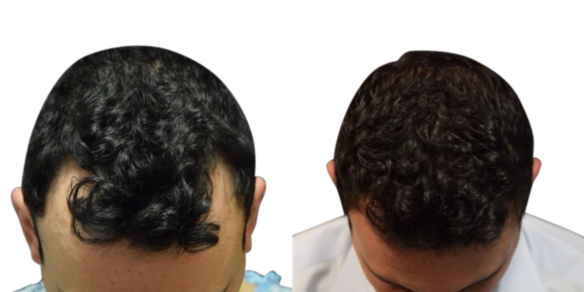 Hair Restoration Before & After Gallery - Patient 427124 - Image 1
