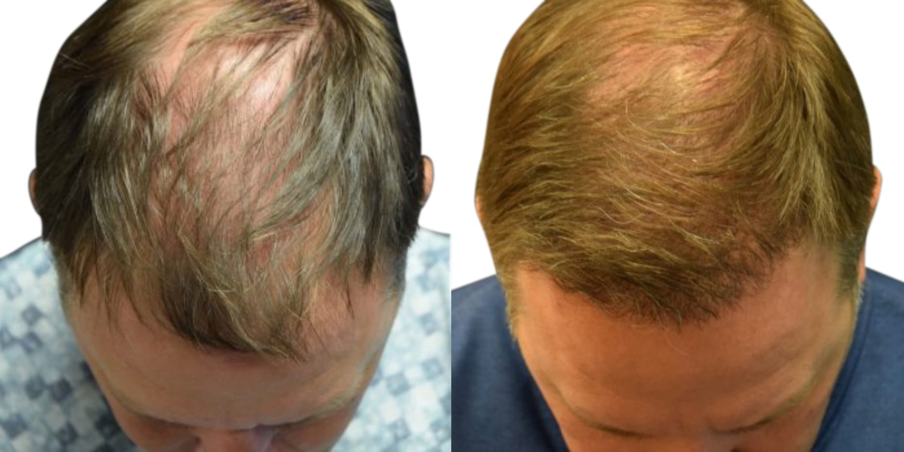 Hair Restoration  Before & After Gallery - Patient 369793 - Image 1