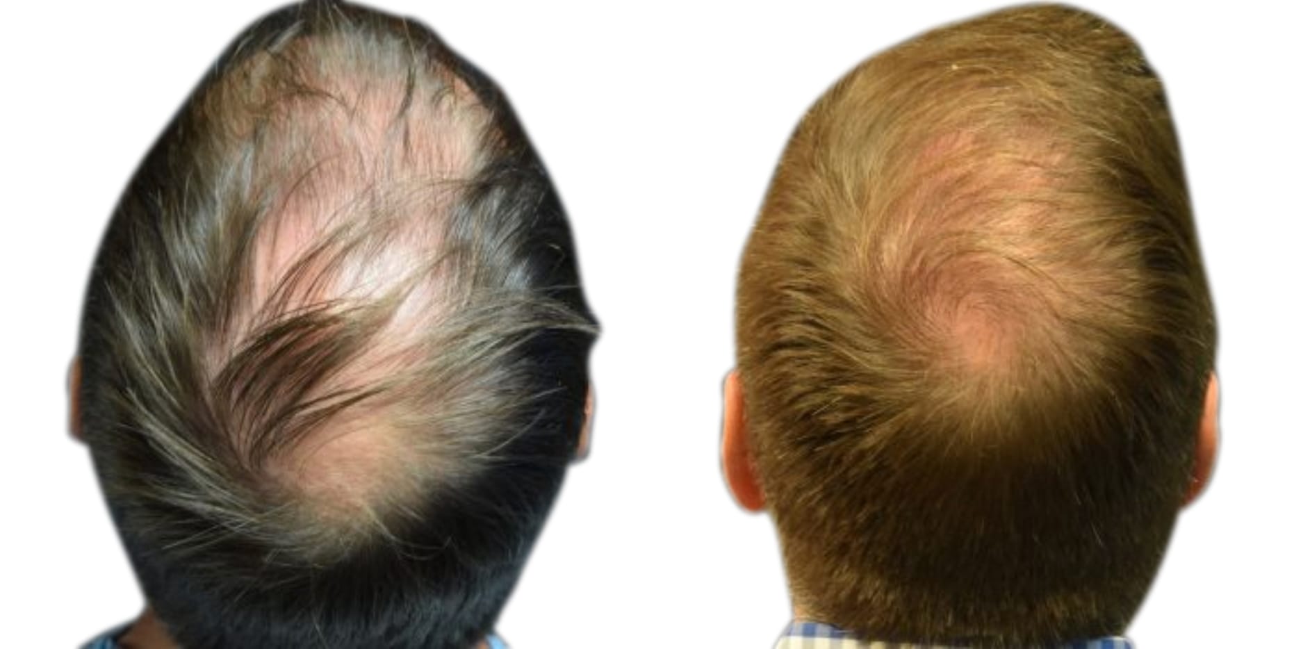 Hair Restoration  Before & After Gallery - Patient 369793 - Image 3
