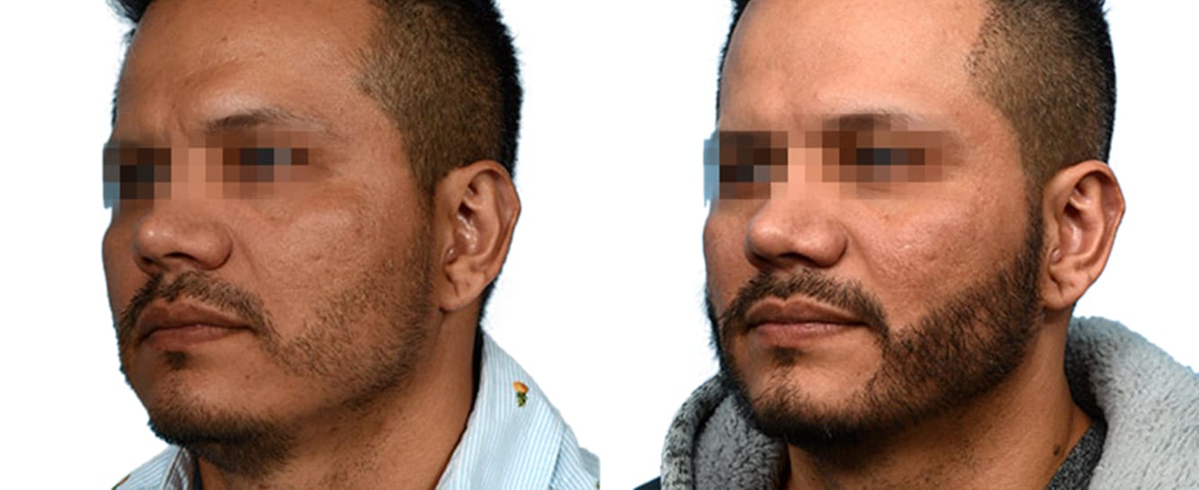 Hair Restoration Before & After Gallery - Patient 250148 - Image 2