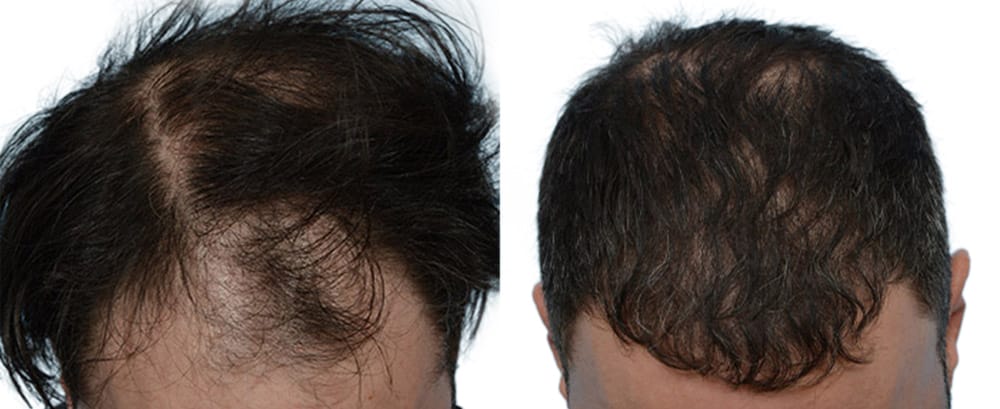 Hair Restoration  Before & After Gallery - Patient 182555 - Image 1