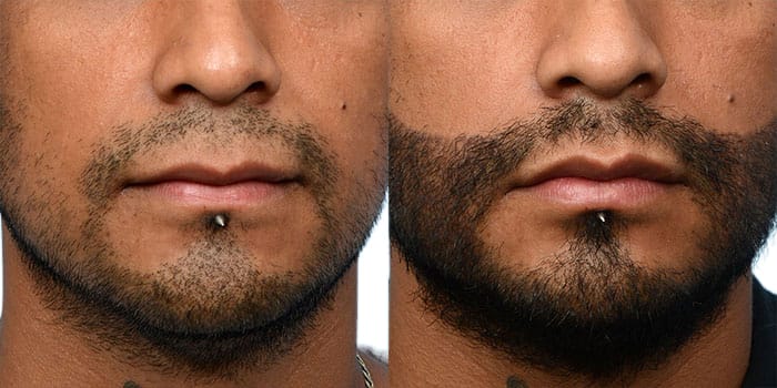 Hair Restoration Before & After Gallery - Patient 540130 - Image 1