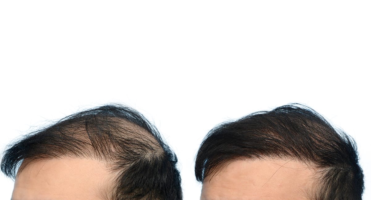 Hair Restoration  Before & After Gallery - Patient 414574 - Image 2