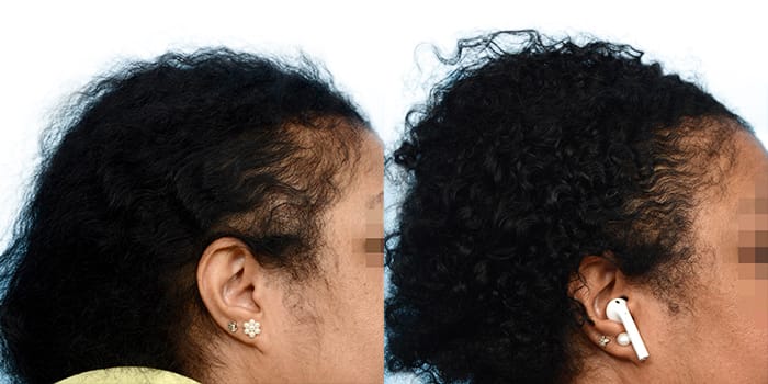 Hair Restoration  Before & After Gallery - Patient 938093 - Image 1