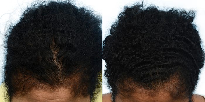 Hair Restoration  Before & After Gallery - Patient 938093 - Image 2