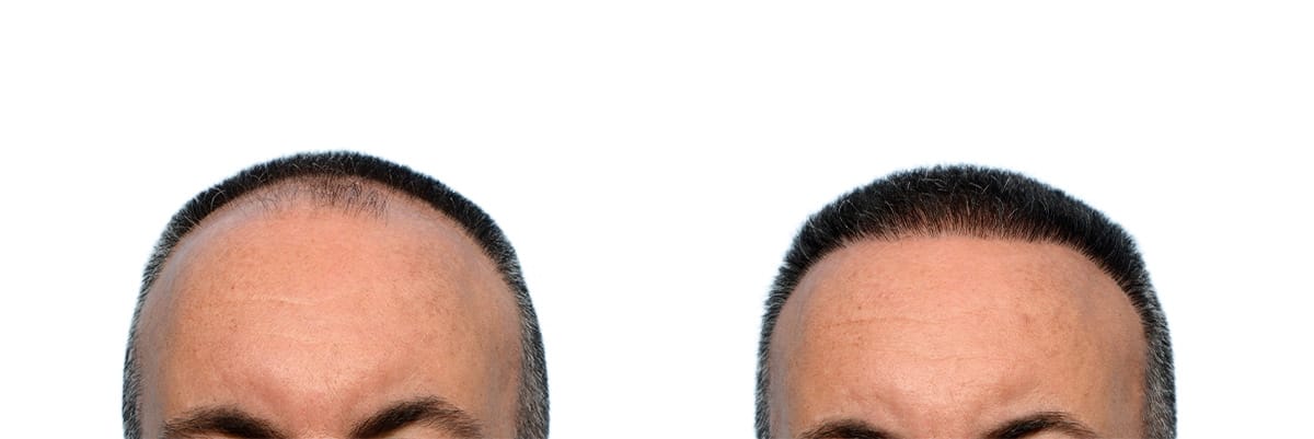 Hair Restoration  Before & After Gallery - Patient 337969 - Image 2