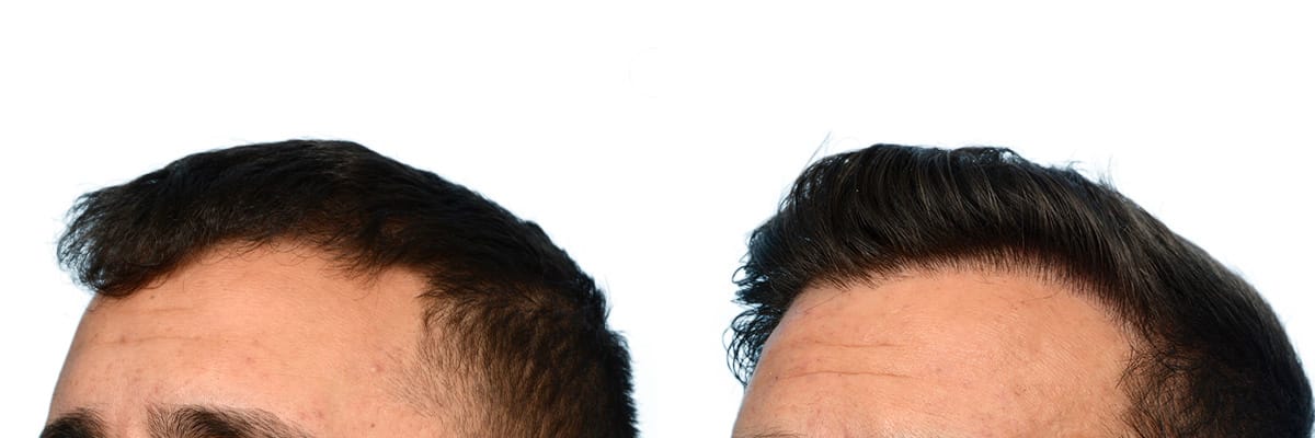 Hair Restoration  Before & After Gallery - Patient 266399 - Image 2