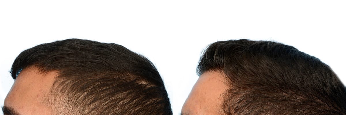 Hair Restoration  Before & After Gallery - Patient 266399 - Image 3