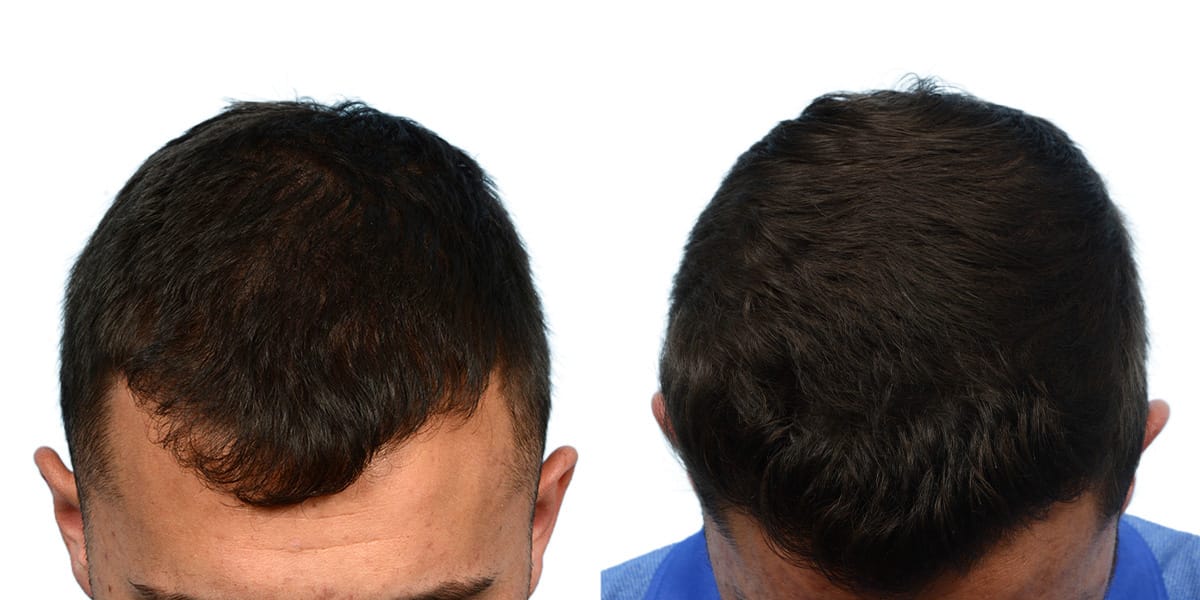 Hair Restoration  Before & After Gallery - Patient 266399 - Image 6