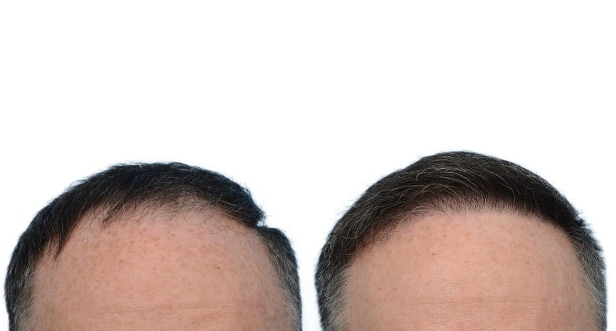 Hair Restoration  Before & After Gallery - Patient 366613 - Image 2