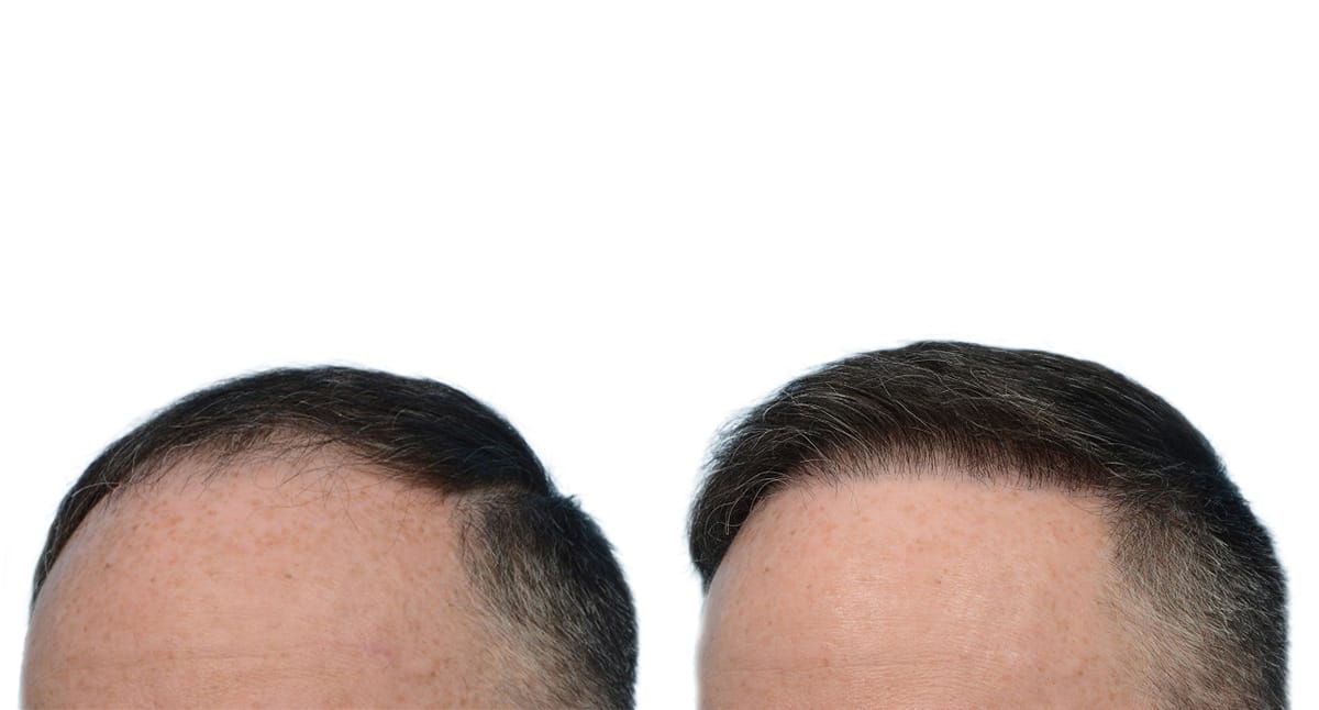 Hair Restoration  Before & After Gallery - Patient 366613 - Image 3