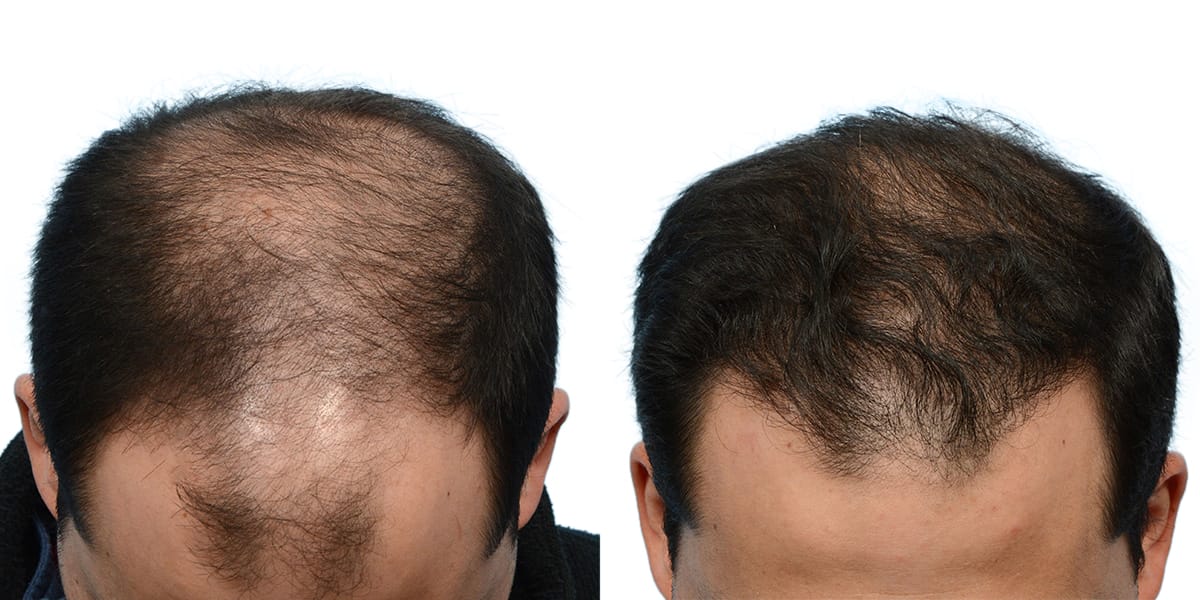 Hair Restoration Before & After Gallery - Patient 366248 - Image 1