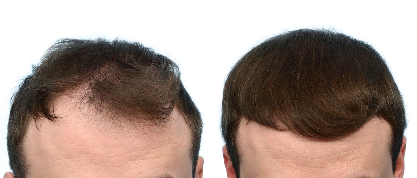 Hair Restoration Before & After Gallery - Patient 133434 - Image 1