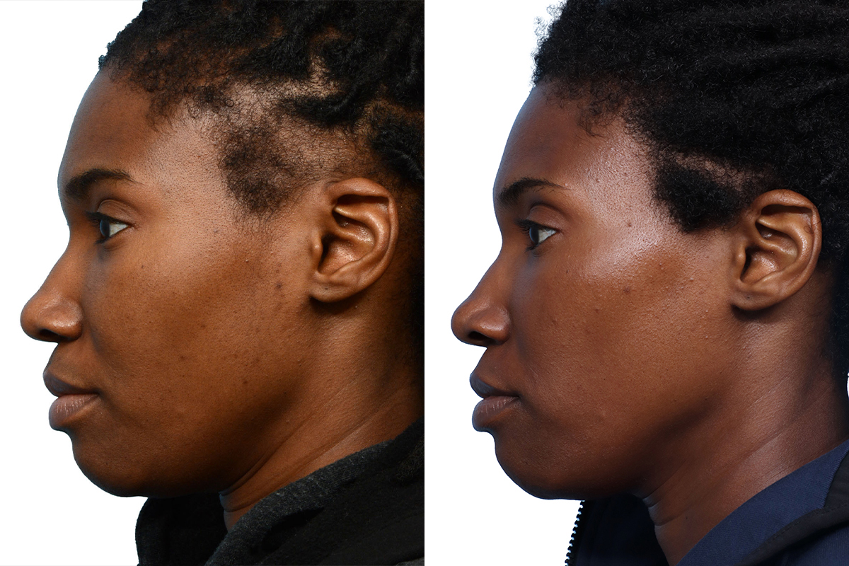 FUT Hair Transplant Before & After Gallery - Patient 381105 - Image 2