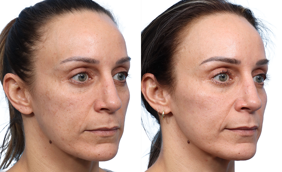 Cool Peel Before & After Gallery - Patient 175623 - Image 1