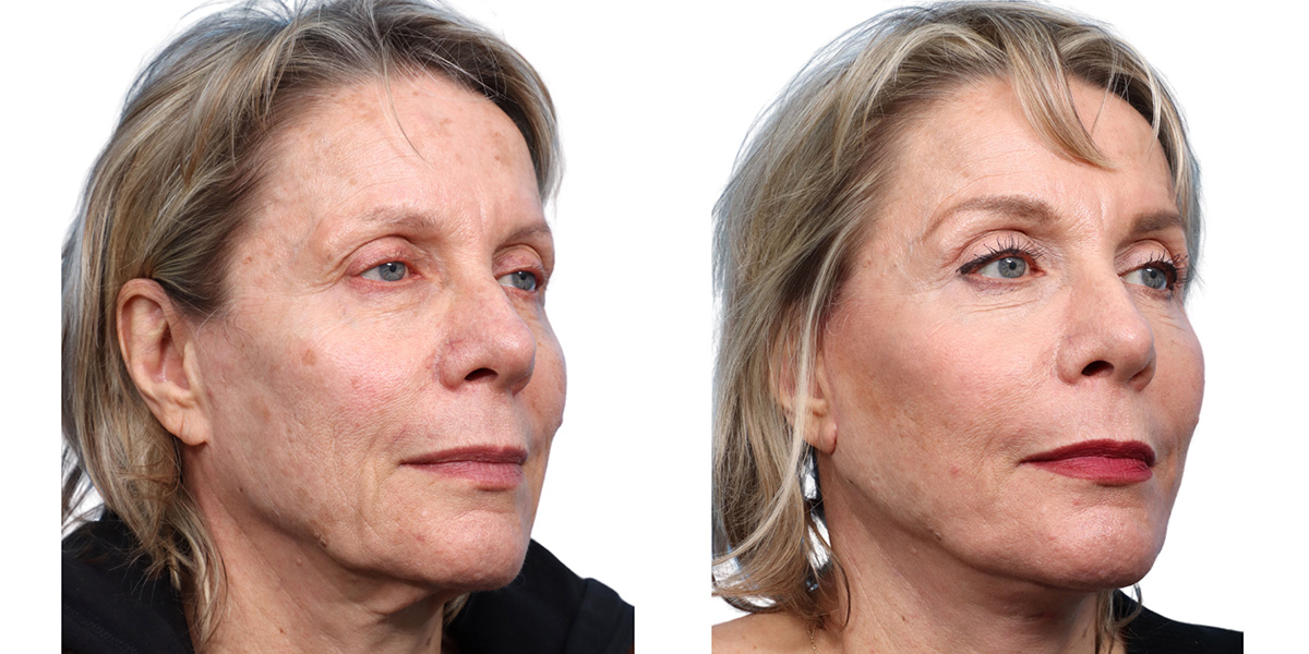 CO2 Laser Before & After Gallery - Patient 273859 - Image 2