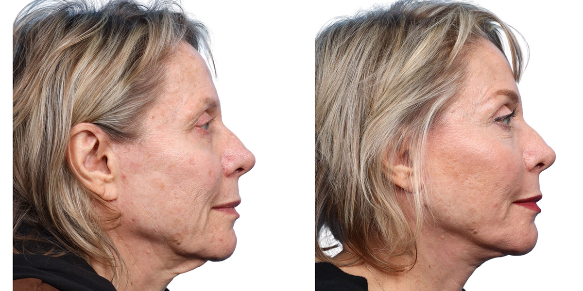 CO2 Laser Before & After Gallery - Patient 273859 - Image 1