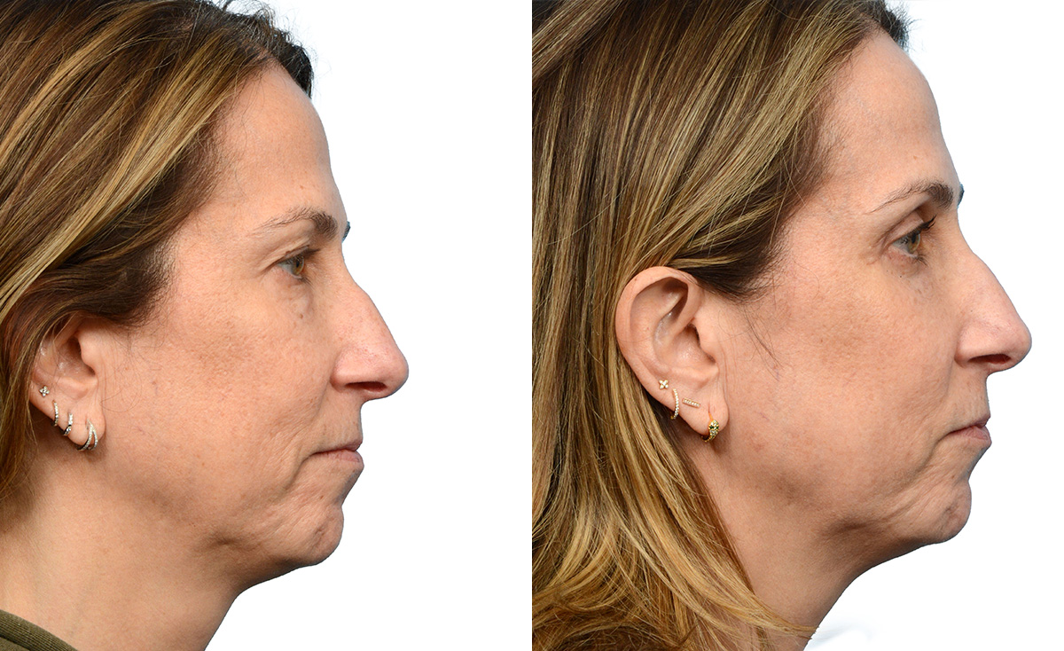 CO2 Laser Before & After Gallery - Patient 164706 - Image 1
