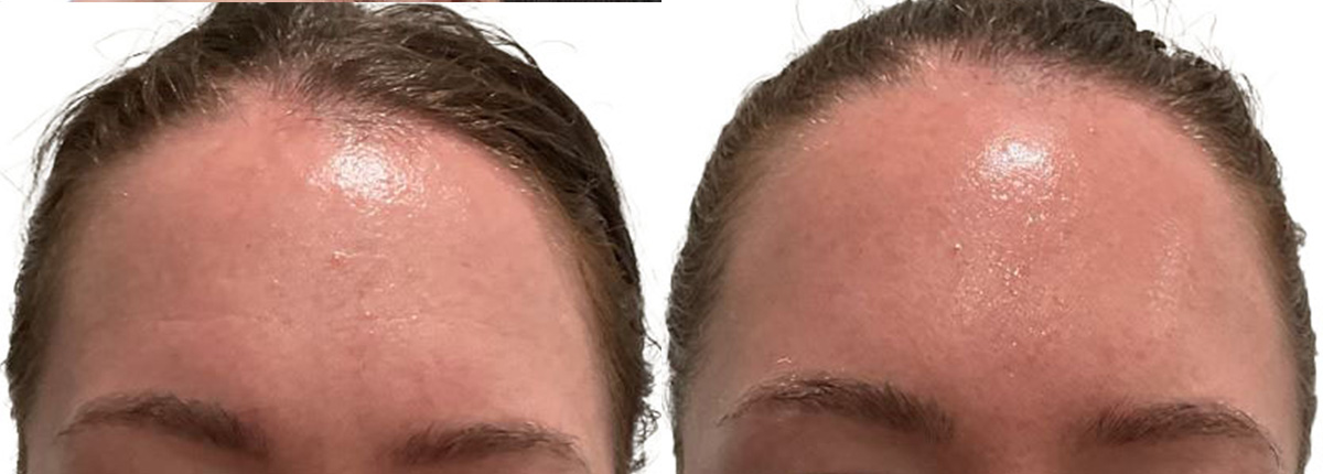 Botox Before & After Gallery - Patient 320446 - Image 1