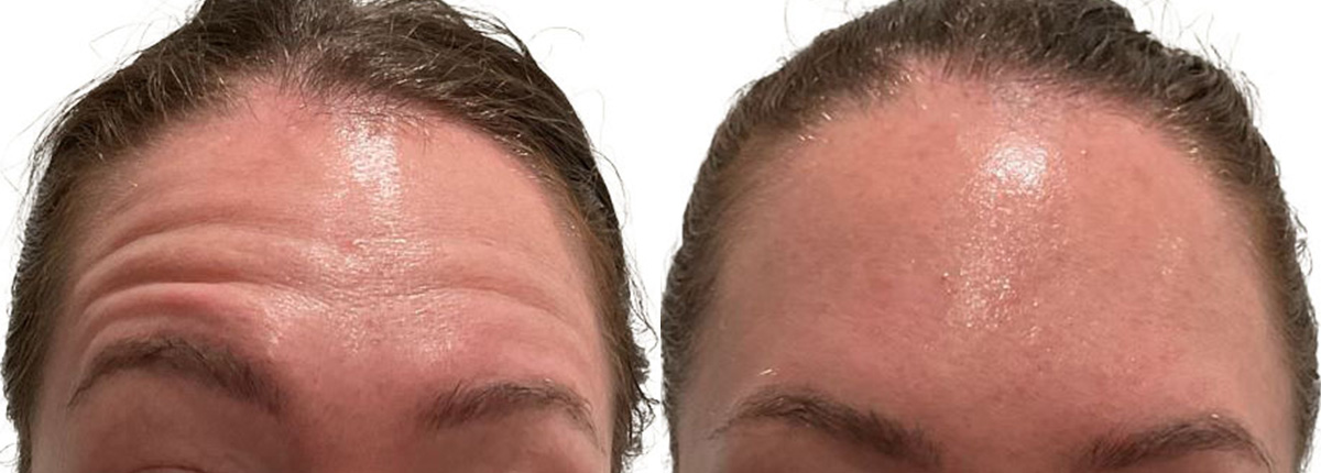 Botox Before & After Gallery - Patient 320446 - Image 2
