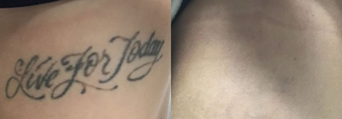 Tattoo Removal Before & After Gallery - Patient 268765 - Image 1