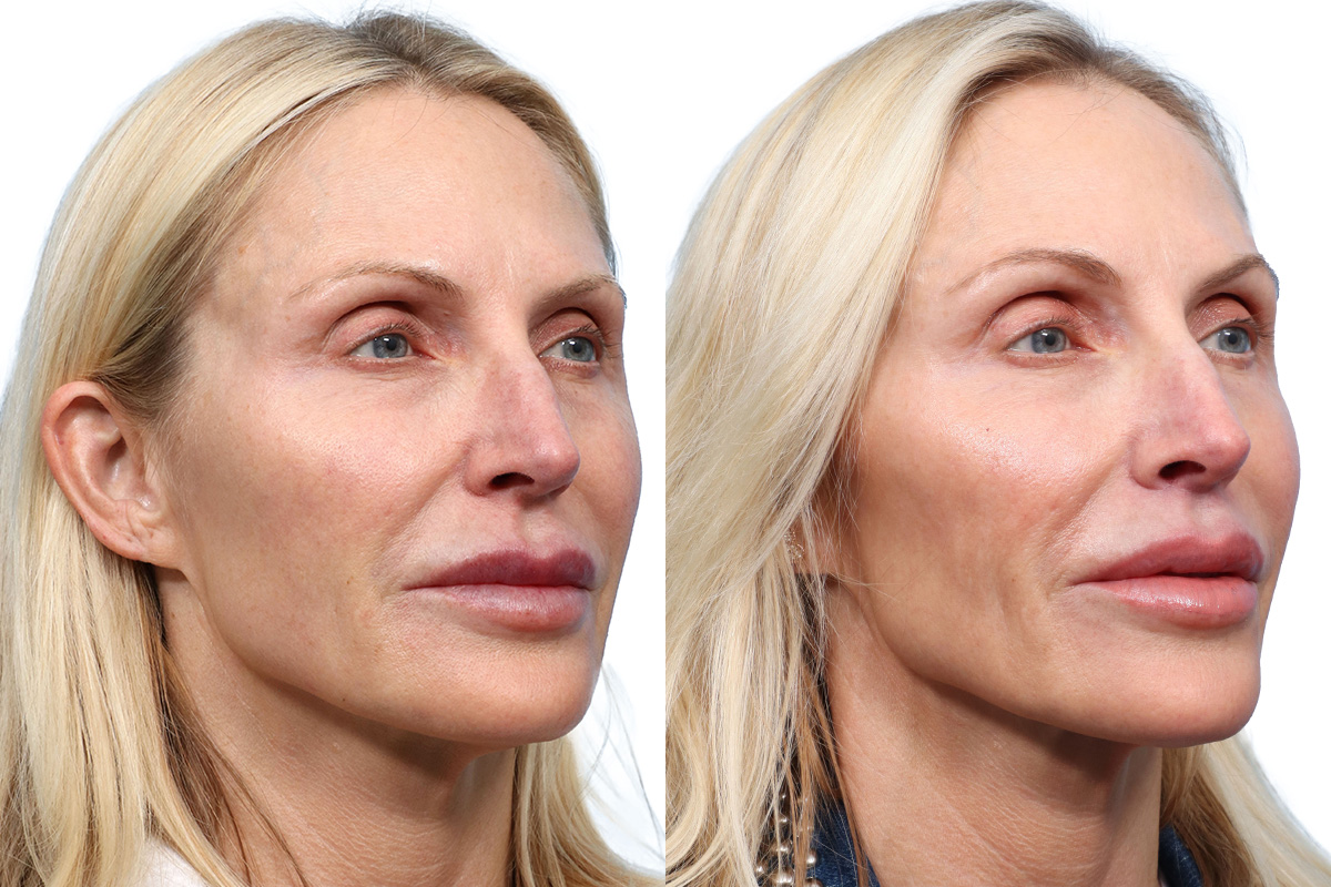Sculptra Before & After Gallery - Patient 215066 - Image 2