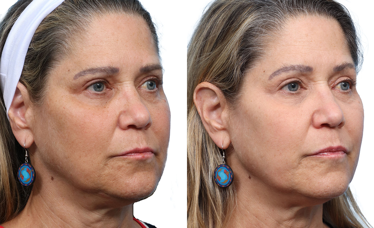 Chemical Peels Before & After Gallery - Patient 157673 - Image 1