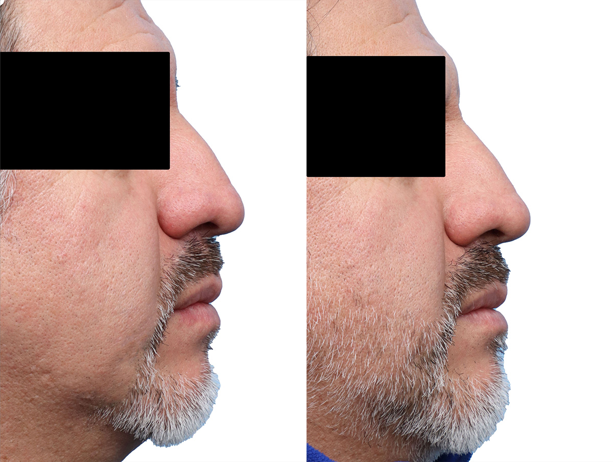 Non-Surgical Rhinoplasty Before & After Gallery - Patient 189267 - Image 1