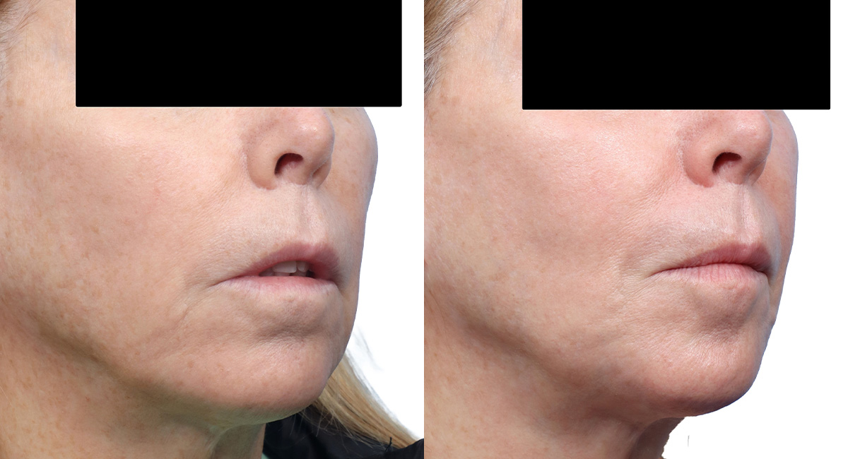 Cool Peel Before & After Gallery - Patient 202993 - Image 2