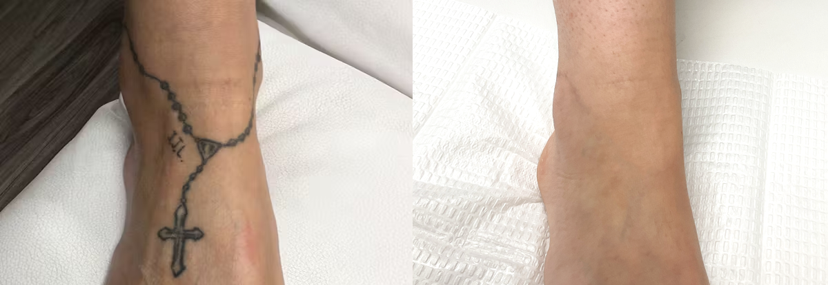 Tattoo Removal Before & After Gallery - Patient 842532 - Image 1