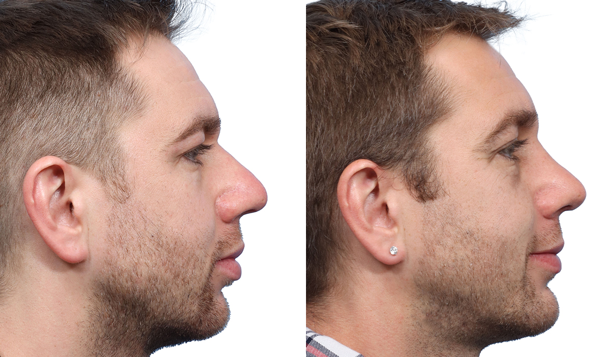 profile of a man after rhinoplasty surgrery