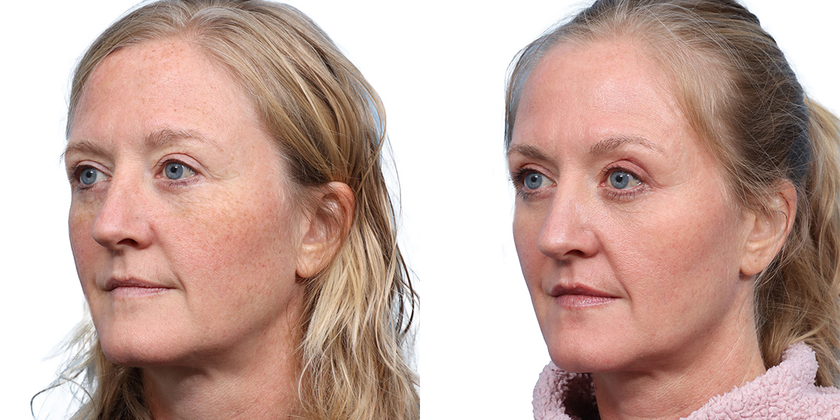 CO2 Laser Before & After Gallery - Patient 116297 - Image 2