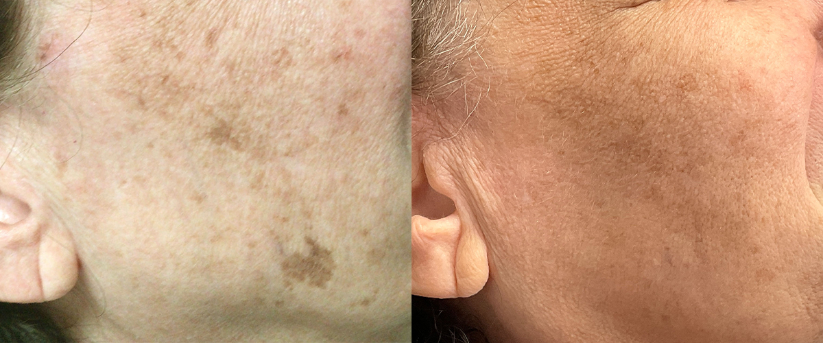 Picoway® Before & After Gallery - Patient 157149 - Image 1