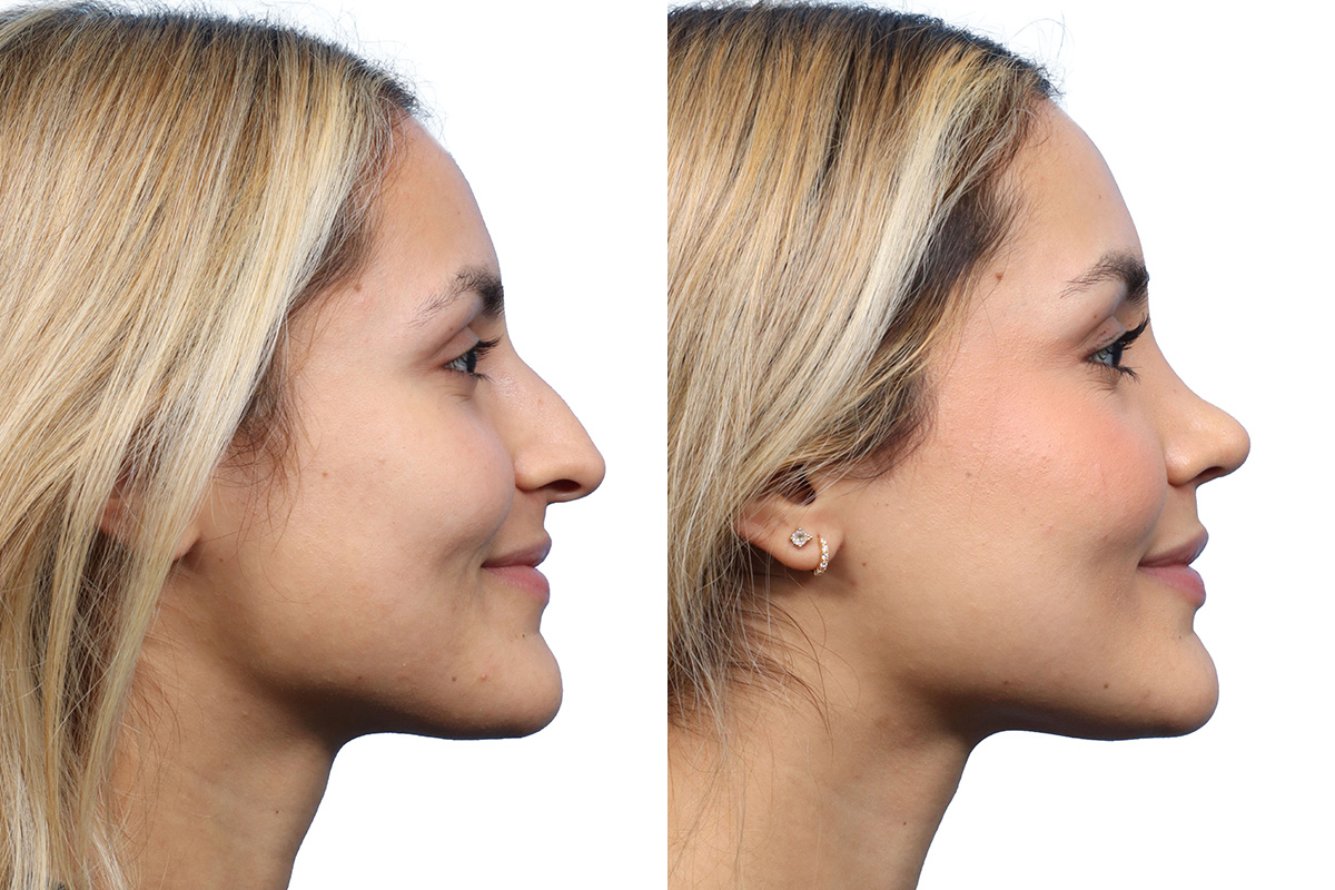 side shot rhinoplasty results