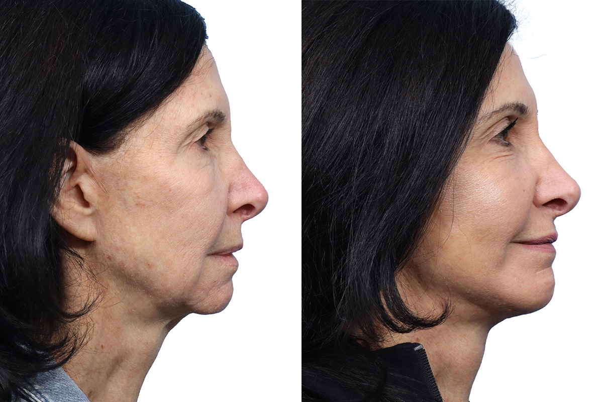 Sculptra Before & After Gallery - Patient 235193 - Image 1