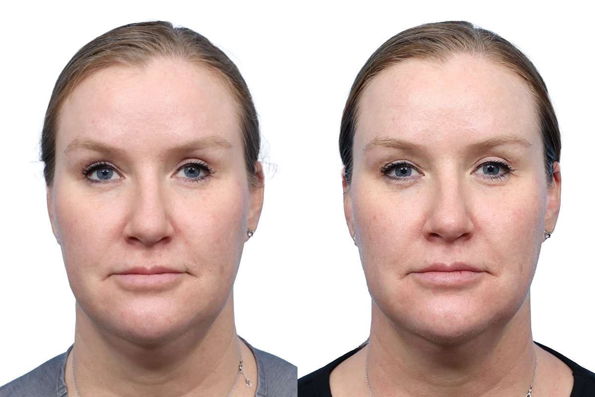 Glacial Skin Rx  Before & After Gallery - Patient 354819 - Image 1