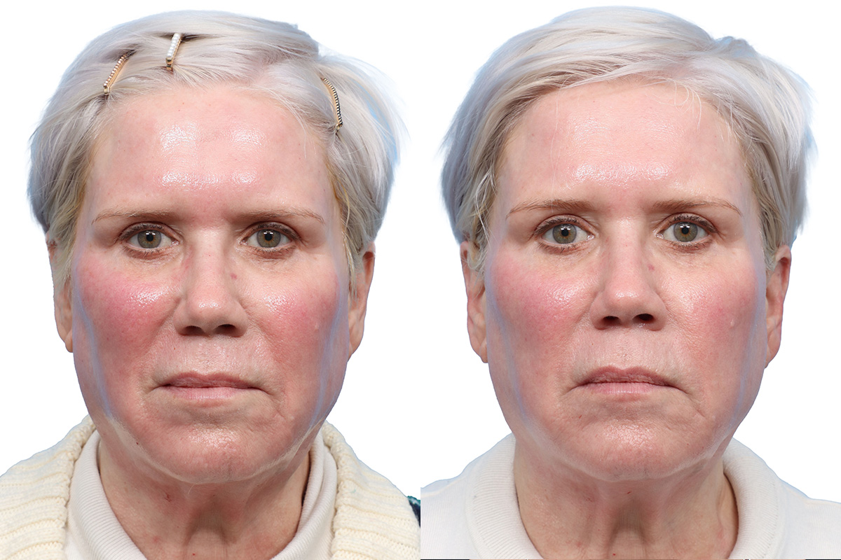 Glacial Skin Rx  Before & After Gallery - Patient 281877 - Image 1