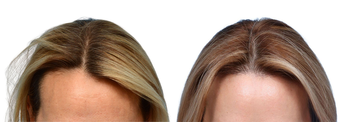 FUT Hair Transplant Before & After Gallery - Patient 107310 - Image 1