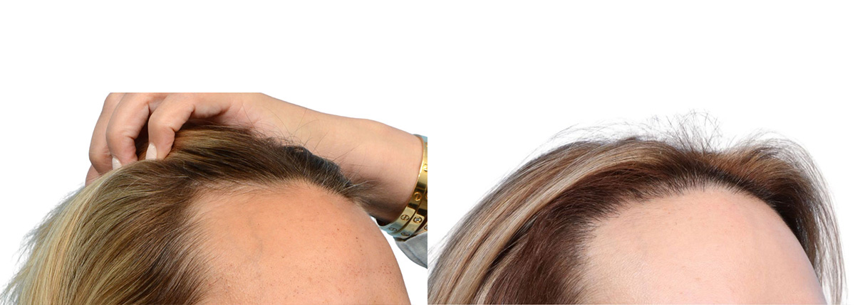 FUT Hair Transplant Before & After Gallery - Patient 107310 - Image 3