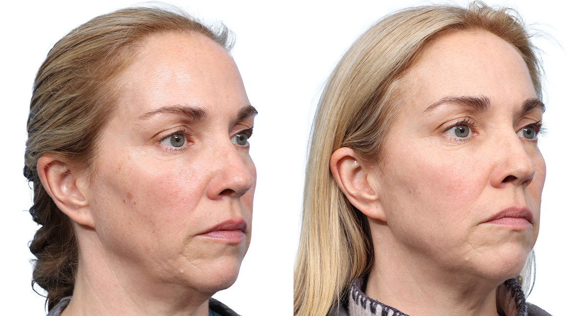 Picoway® Before & After Gallery - Patient 161342 - Image 2