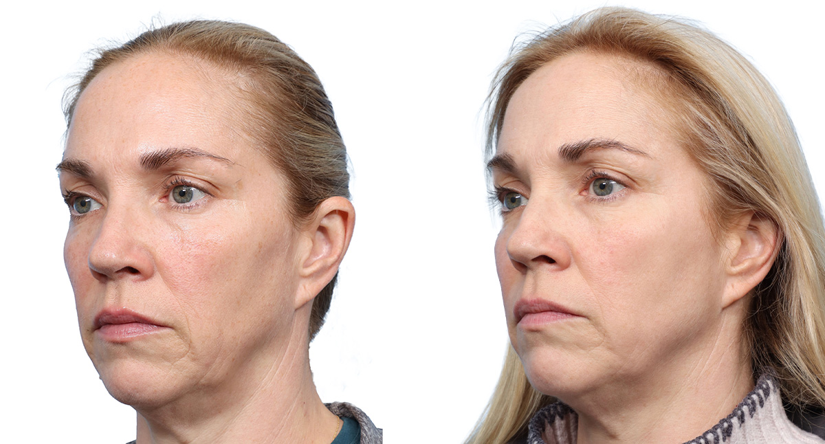 Picoway® Before & After Gallery - Patient 161342 - Image 3
